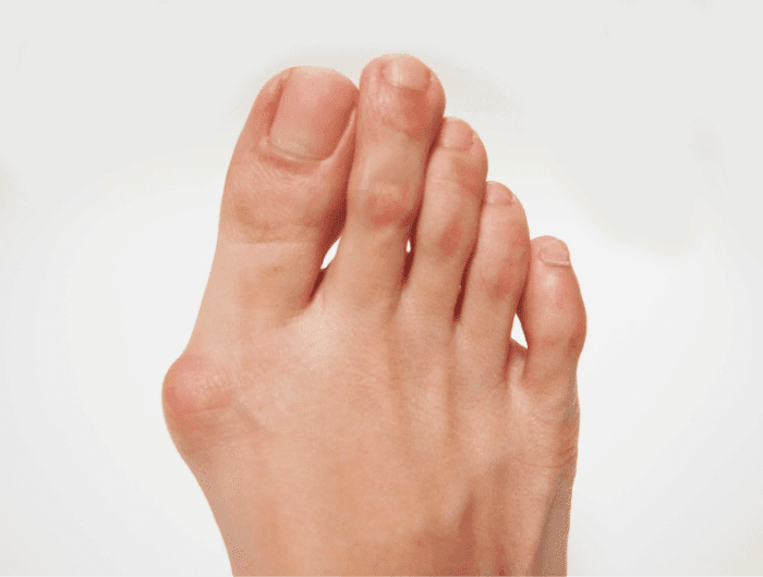 Corn Callus Or Bunion At Megan Richter Blog