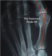 foot mobilisation for bunion treatment sydney